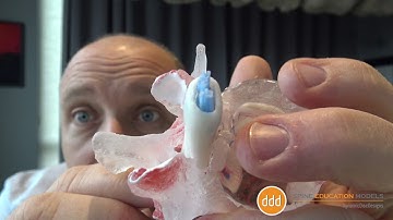 Clinical Tips using the ProLxH Dynamic Disc Model 2020 Edition - Dural Sac Encroachment