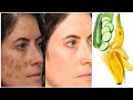 Banana peel face mask to remove age spots naturally in 3 days!! age spot removal home remedies!