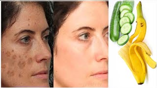 Banana peel face mask to remove age spots naturally in 3 days!! age spot removal home remedies!