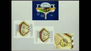 Dr.Sami Aleissa - Cervical Foraminotomy screenshot 2