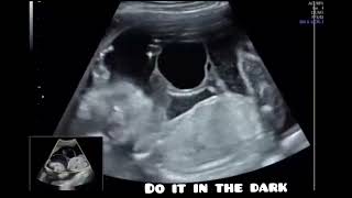 umbilical cord cyst #ultrasound #radiology #ultrasoundscans #obstetrics @DoItInTheDark