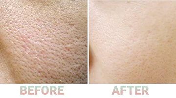 Comment resserrer les pores très dilatés