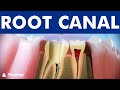 ROOT CANAL treatment step by step  - 3D video of endodontics for tooth decay ©