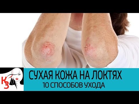 СУХАЯ КОЖА НА ЛОКТЯХ. 10 Способов ухода за локтями в домашних условиях