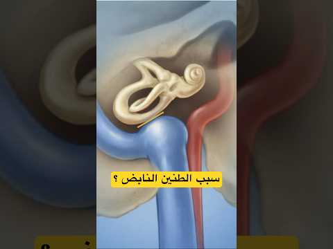 سبب الطنين النابض مشكلة في الأوعية الدموية طنين الأذن الأشعة التداخلية