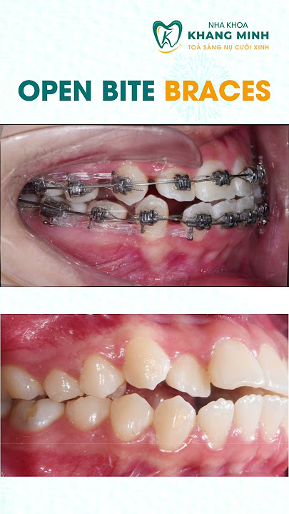 Overbite Braces #shorts #braces #orthodontist #dentist