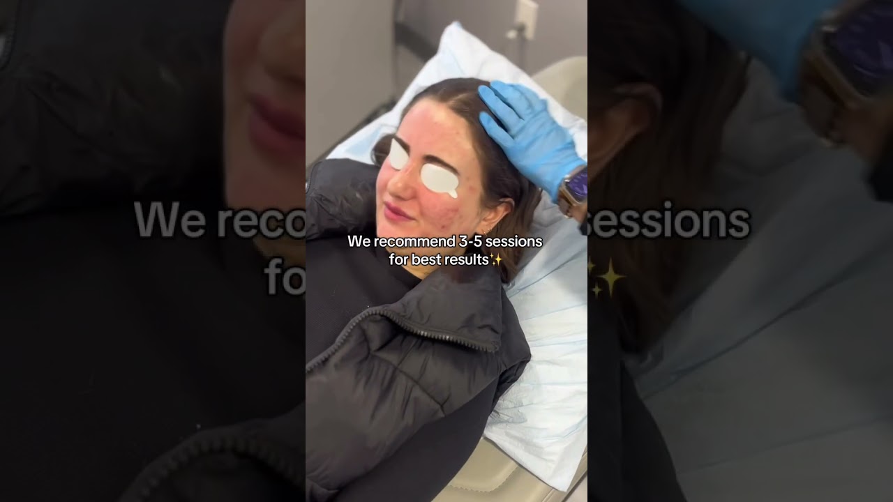 Watch redness disappear in seconds‼️✨