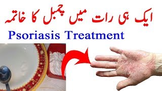 Psoriasis Treatment - Chambal Ka Ilaj