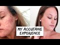 How i cleared my acne  my accutane experience before  after pics