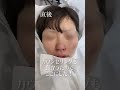 【鼻翼縮小/小鼻】小鼻の広がりがマジで無理 #shorts