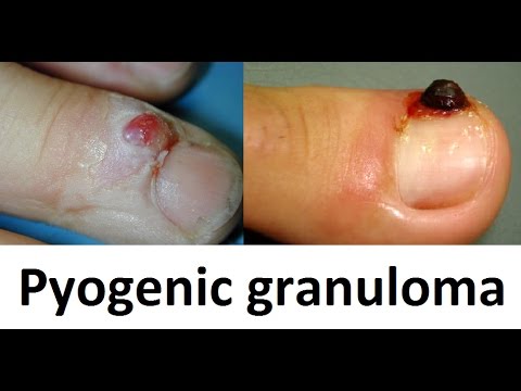 Video: 3 Cara Merawat Granuloma Pyogenik