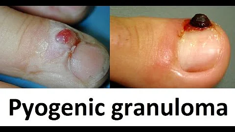O que é granuloma Pós-cirúrgico?
