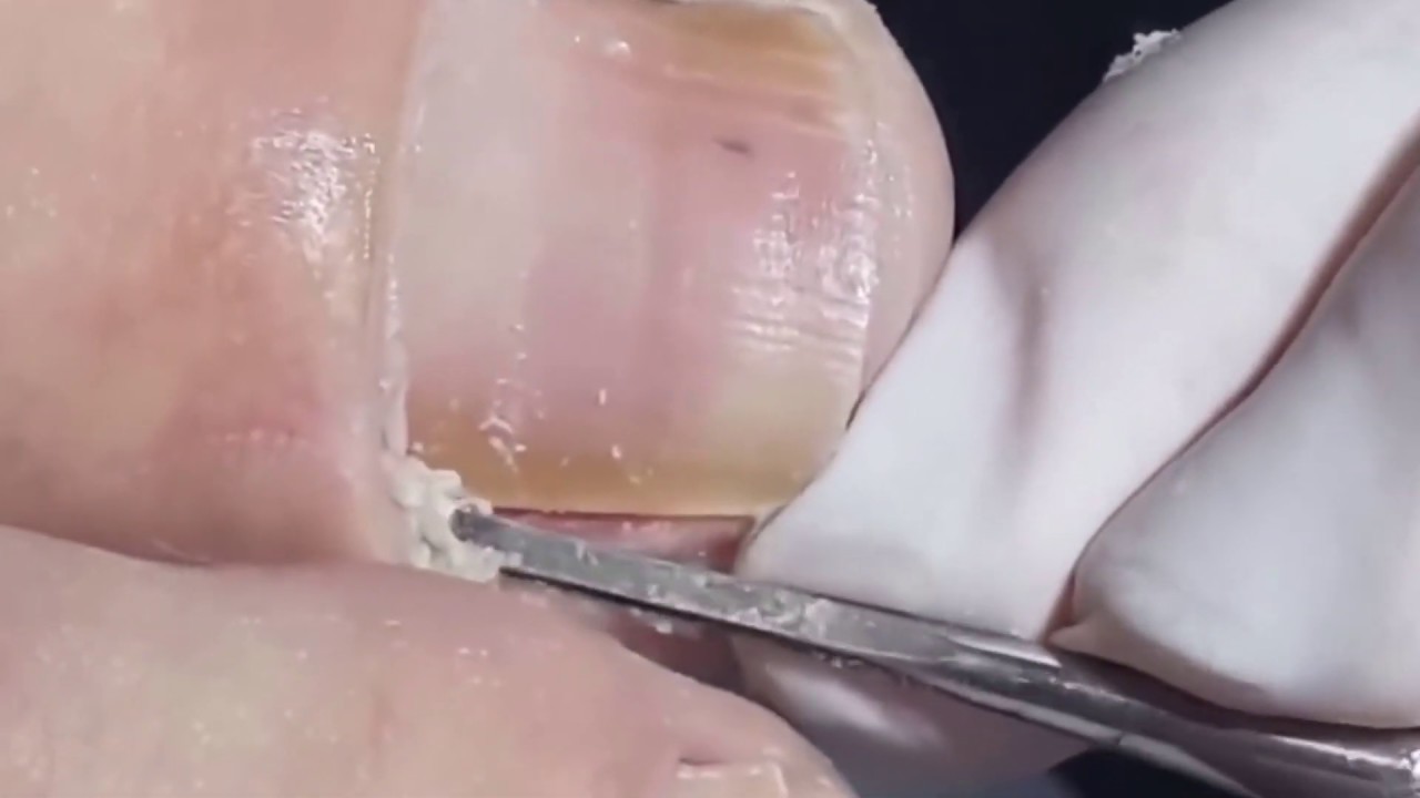 NAIL INGROWN REMOVAL COMPILATION (1) EXTREMELY SATISFYING! YouTube