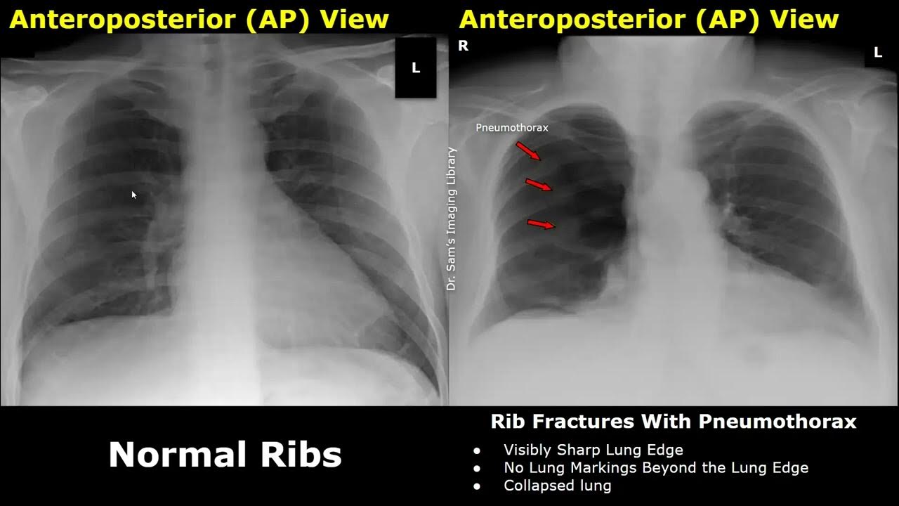 chest-x-ray-ribs-normal-vs-abnormal-image-appearances-fractures