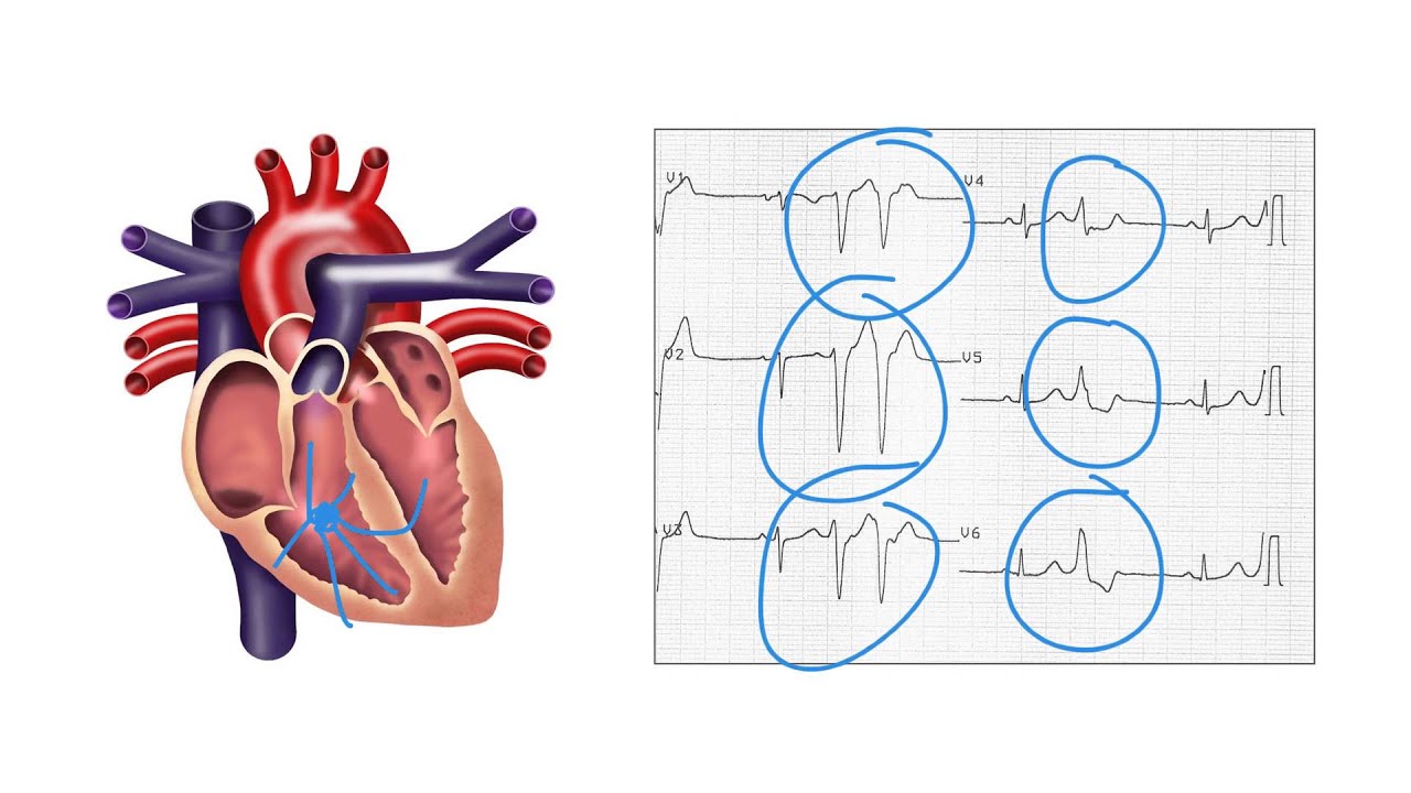 Determining the origin of ventricular ectopic beats on ECG Ask Andrew - YouTube