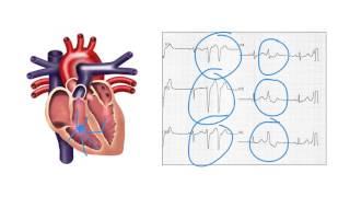 Determining the origin of ventricular ectopic beats on the ECG - Ask Andrew