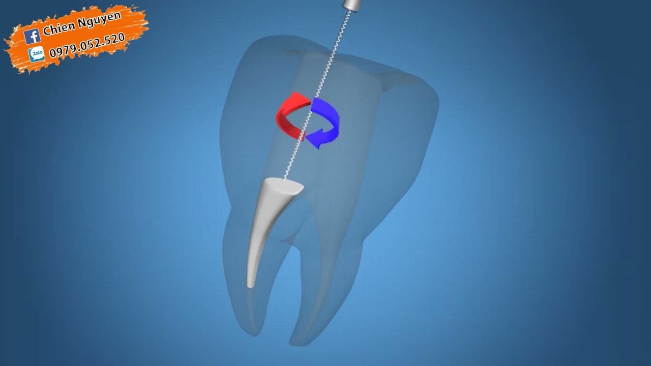 CÁCH SỬ DỤNG ENDOSEALMTA