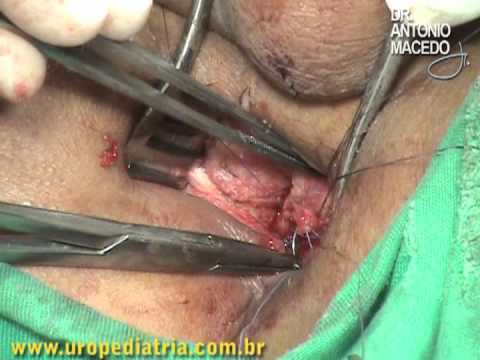 Cirurgia de Ausência de Penis Técnica de De Castro_Afalia_ Penile aphallia_Dr  Antonio Macedo Jr
