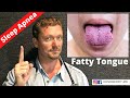 1 Cause of SLEEP APNEA You’ve Never Heard of? (Fatty Tongue) 2020