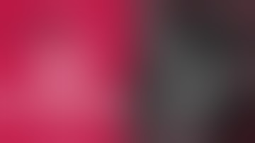 #23, 25 implant placement with ridge split and enucleation of a radicular cyst [Dr. Cho Yongseok]