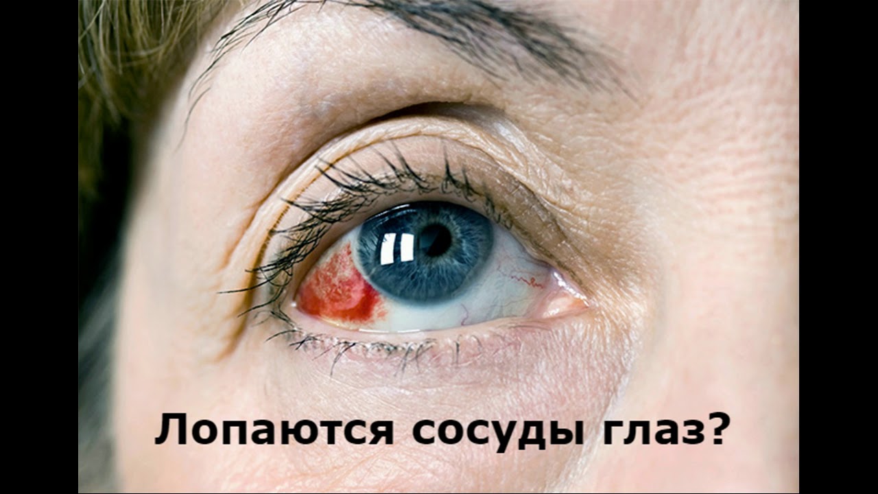 Что делать если идет кровь из носа, появляются синяки, лопаются сосуды глаз?