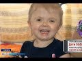 Соня Плоскарева, 2 года, синдром Апера, деформация черепа