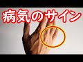 手が教えてくれる病気のサインがコレ！
