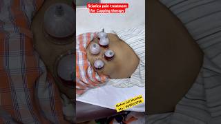 Is hijama good for sciatica pain? #kzhijama #pain #painrelief #scitica #shorts #youtube #reels