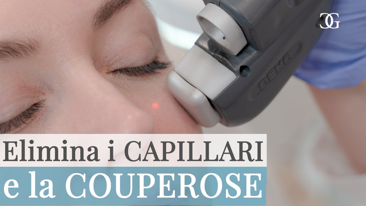 Come eliminare i CAPILLARI e la COUPEROSE con il LASER - Dr.ssa Beatrice GIORGINI
