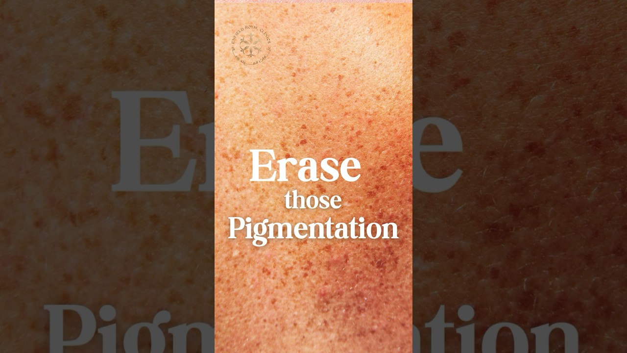 Erase Pigmentation with Pico Laser: Watch the Transformation! 