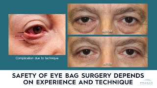 Dark Circles/Eye Bags | Dr. Brett Kotlus, Cosmetic Oculoplastic Surgeon, NYC