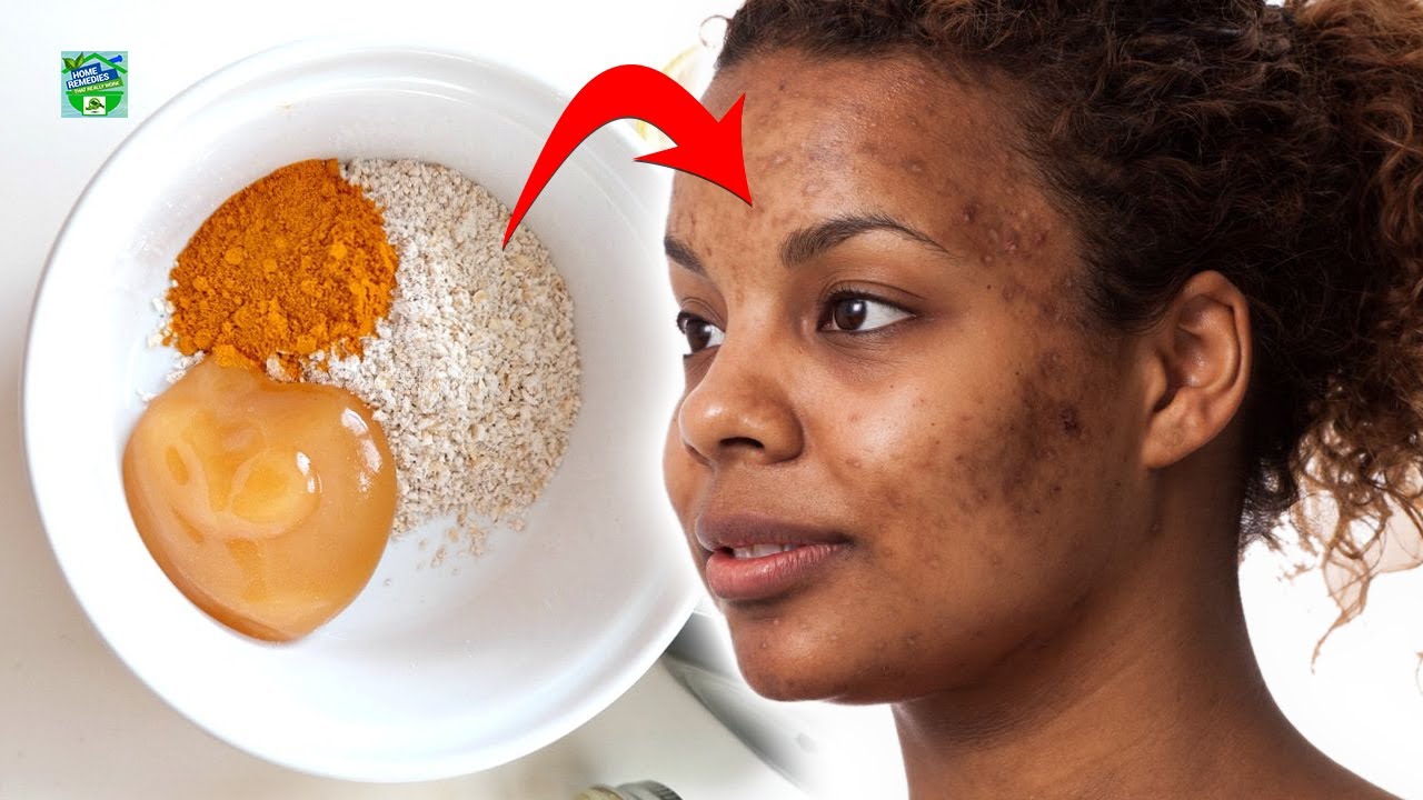 This Turmeric Mask for Acne Is Everything Your Skin Needs YouTube