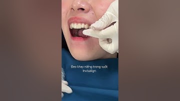 Đeo khay niềng trong suốt Invisalign #niengrang