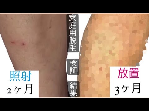 【脱毛】家庭用脱毛器を２ヶ月使った後、３ヶ月放置したら...