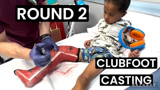 UPDATE ON 4 YEAR OLD CLUBFOOT RELAPSE | CLUBFOOT JOURNEY