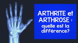 Arthrite et arthrose : voici les différences que vous devriez connaître