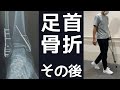 【夫婦登山】足首骨折手術後の経過|退院から登山再開までのリハビリや生活について