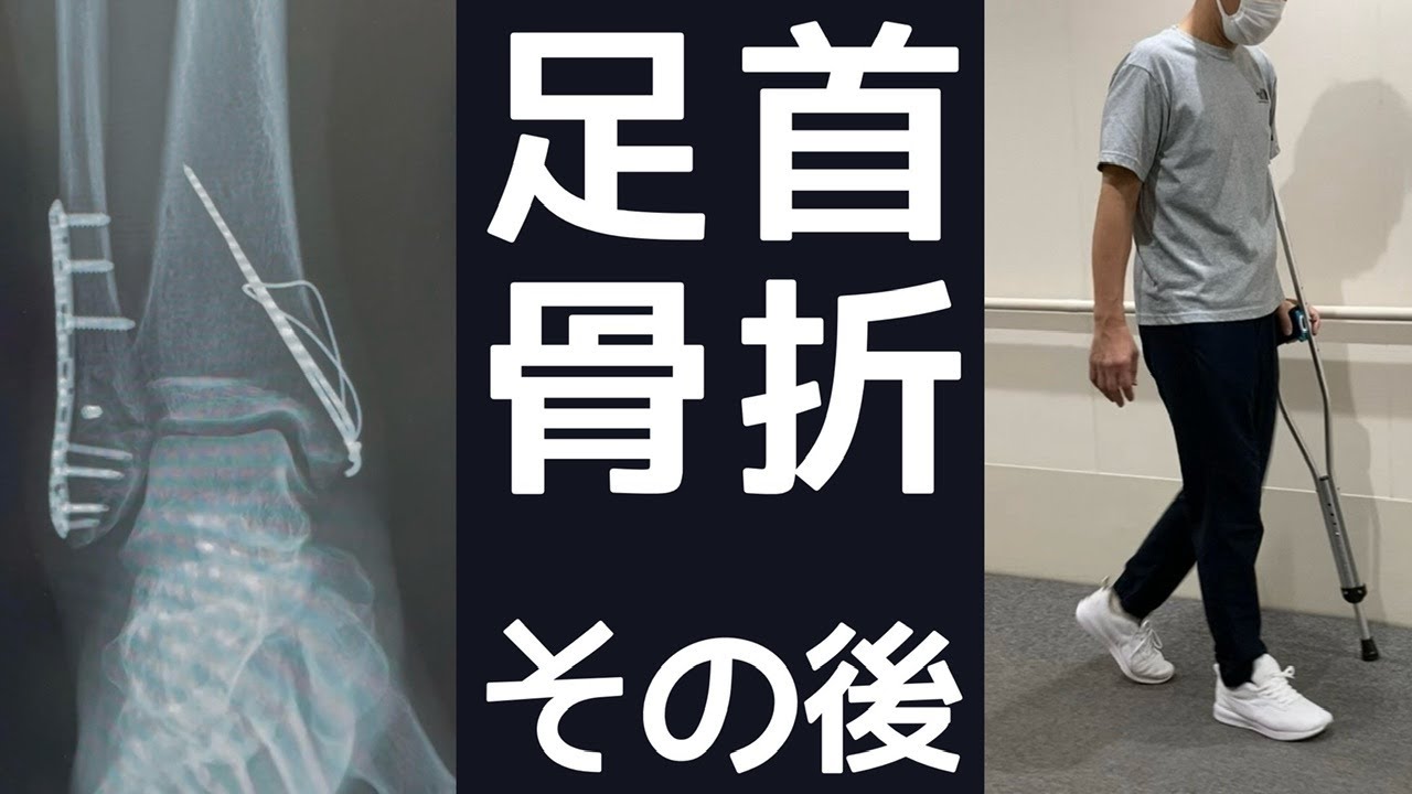 【夫婦登山】足首骨折手術後の経過｜退院から登山再開までのリハビリや生活について