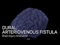 Normal Vascular Anatomy and Dural Arteriovenous Fistula (DAVF)