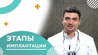 🦷 Этапы имплантации зубов: диагностика, сроки и особенности. Этапы имплантации зубов видео. 18+