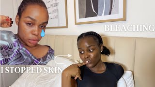 Story Time|I stopped Bleaching My Skin