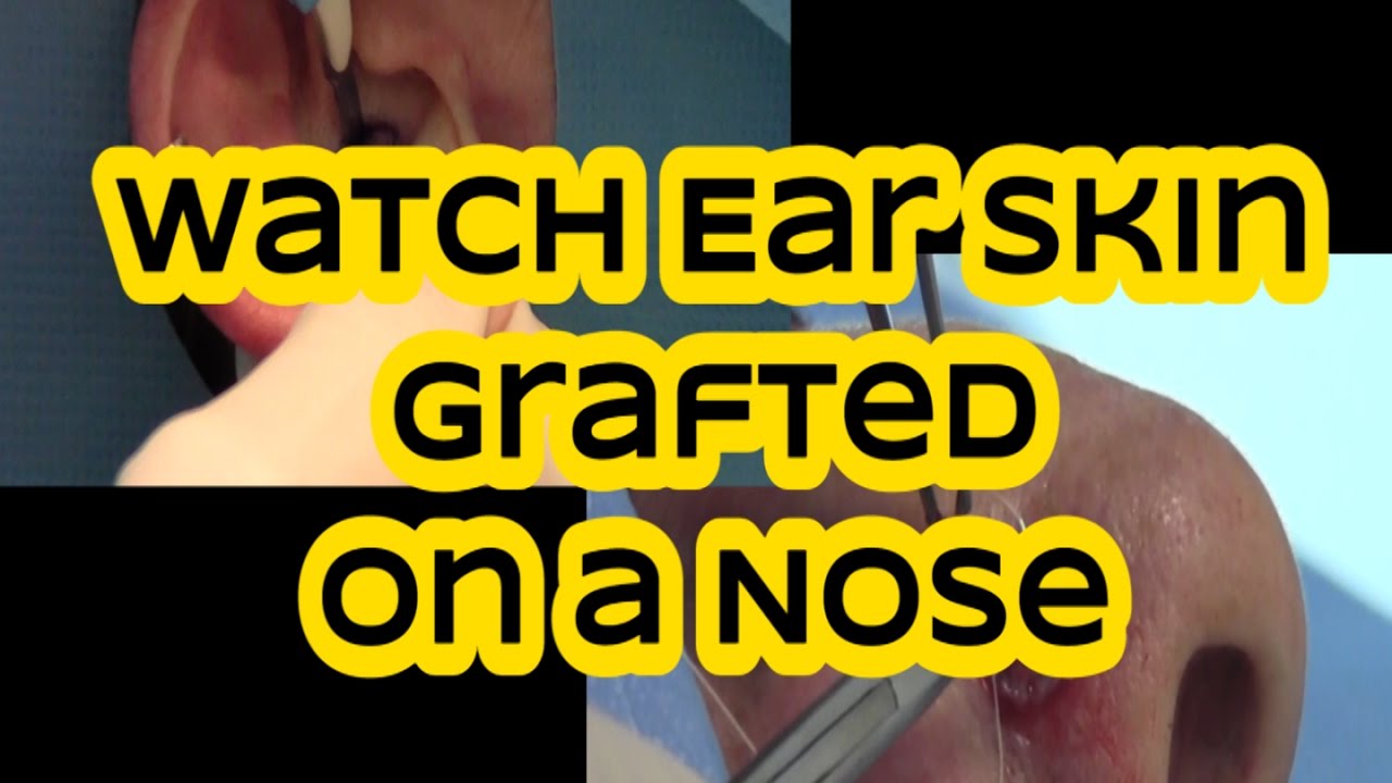Cosmetic Surgeon Uses Ear Skin to Graft into Skin Cancer Site on Nose