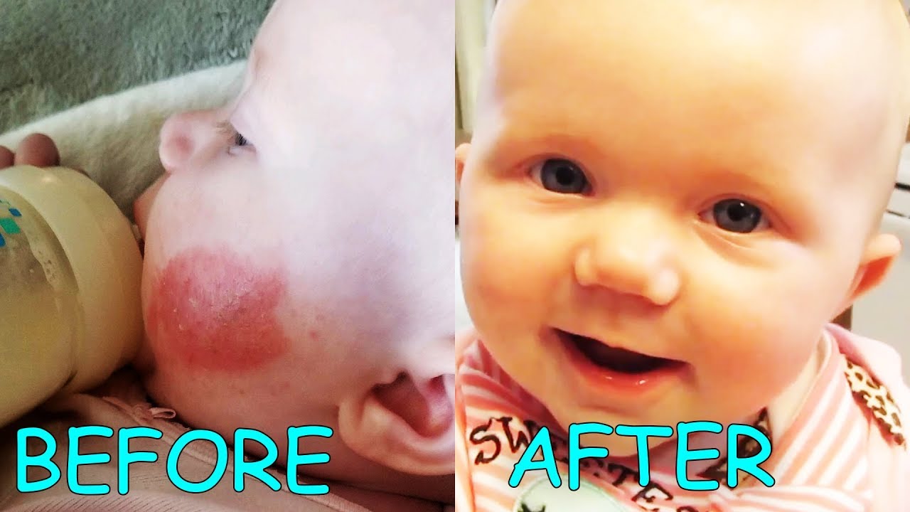 How To Get Rid Of Eczema On Face Baby Baby Eczema Treatment 5 At Home