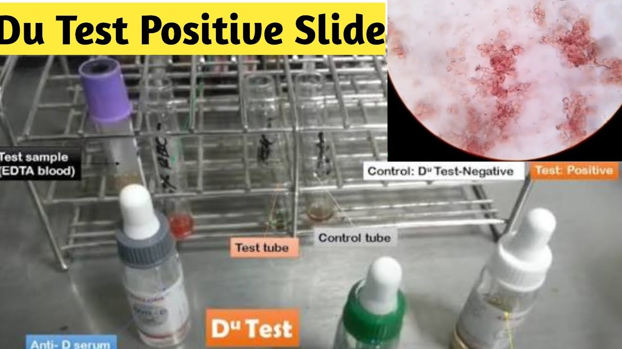 Du Test Procedure |Du Positive Slide|Negative Blood group Confirmation Test|