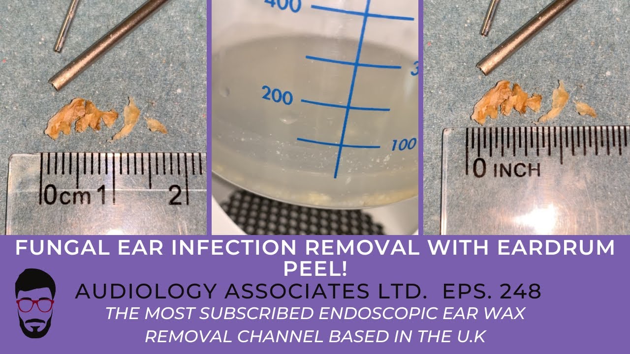 FUNGAL EAR INFECTION REMOVAL WITH EARDRUM PEEL EP 248 YouTube