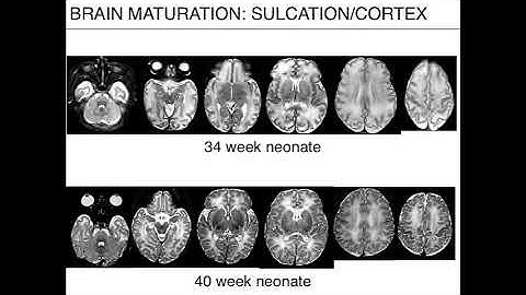 ISMRM MR Academy - Developmental Neuroanatomy 101 - All you need to know to better the appearance...