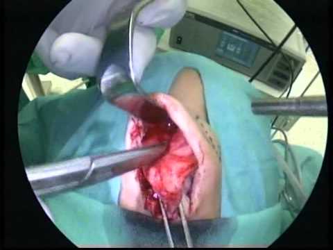 Live Surgery Course Of The Nose And Paranasal Sinuses - Operation 6 (part 1)
