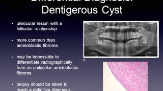 Ameloblastic Fibroma