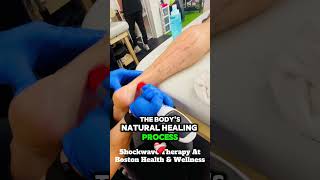 How Shockwave Therapy Works