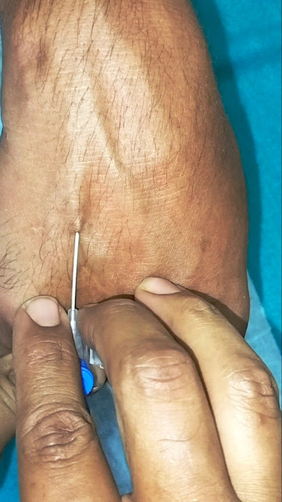 Cannula Insertion Made Easy: Tips & Techniques#yt#iv#viralshort#trending